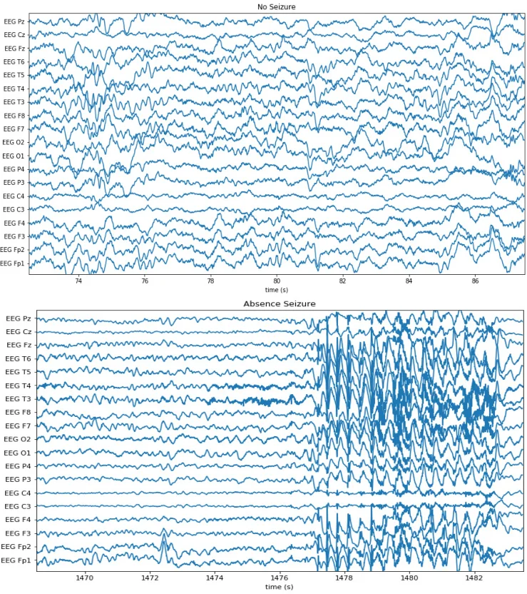 A 6.3pJ/b 30Mbps -30dB SIR-tolerant Broadband Interference-Robust Human   Body Communication Transceiver using Time Domain Signal-Interference   Separation