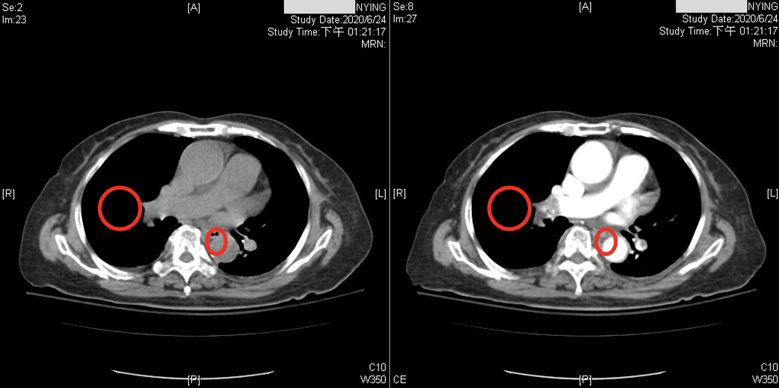 Application of deep learning techniques in non-contrast computed tomography pulmonary angiogram for pulmonary embolism diagnosis