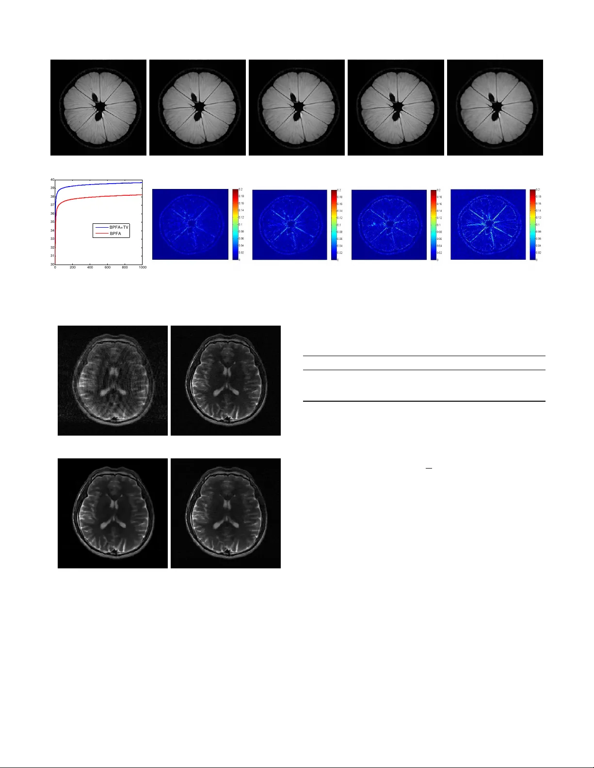 Bayesian Nonparametric Dictionary Learning for Compressed Sensing MRI