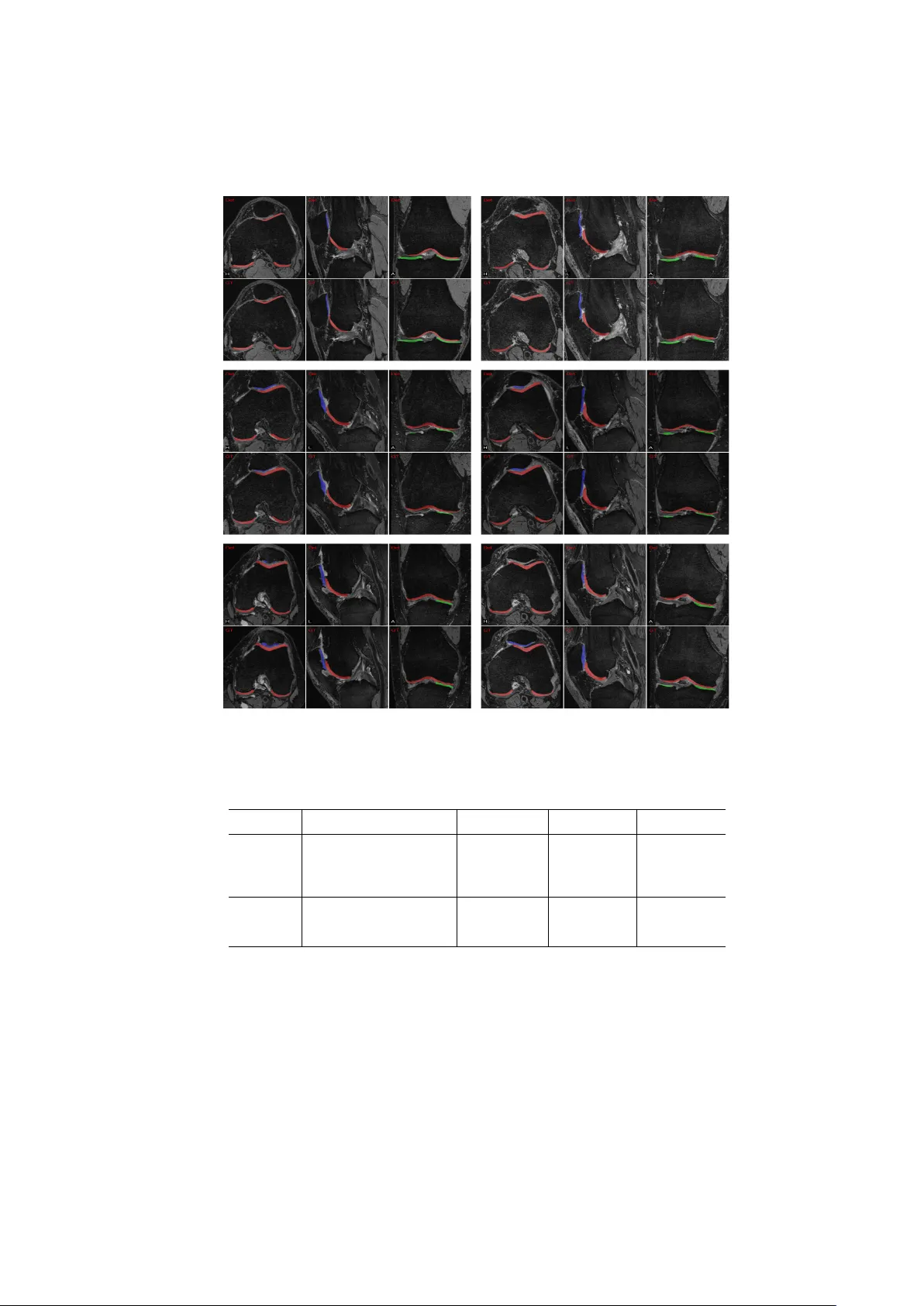 Semantic Context Forests for Learning-Based Knee Cartilage Segmentation   in 3D MR Images