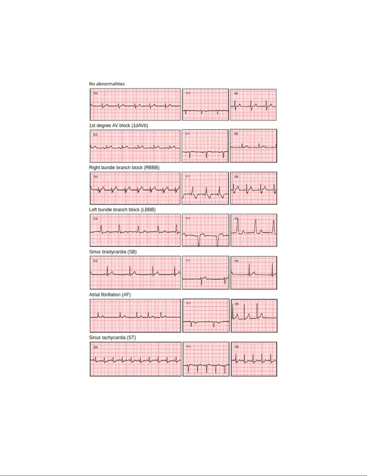 Automatic Diagnosis of Short-Duration 12-Lead ECG using a Deep   Convolutional Network