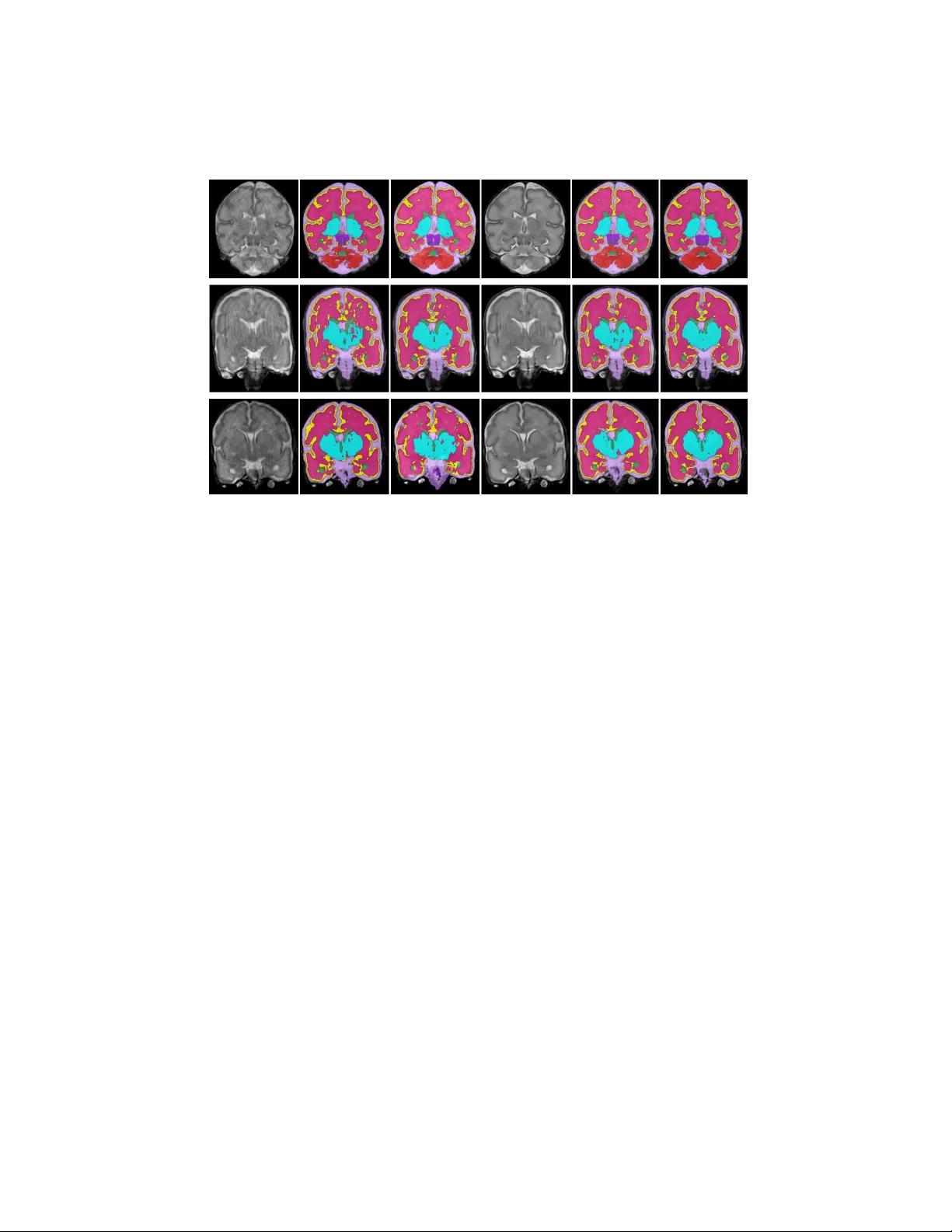 Generative adversarial network for segmentation of motion affected   neonatal brain MRI
