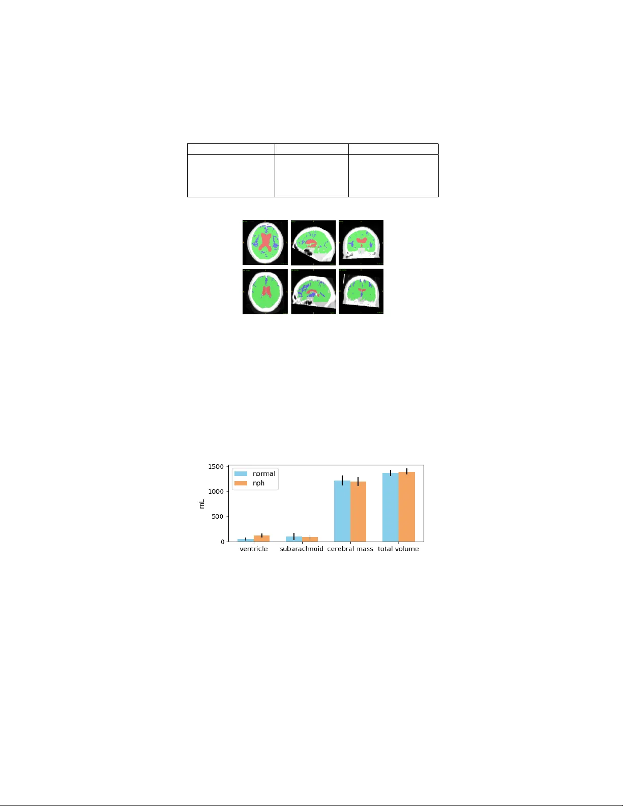 Automated Segmentation of CT Scans for Normal Pressure Hydrocephalus