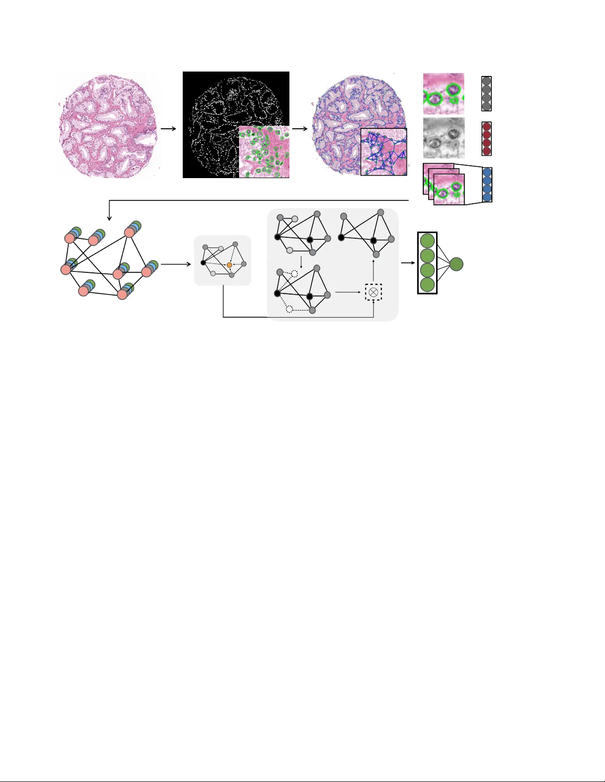 Weakly Supervised Prostate TMA Classification via Graph Convolutional   Networks