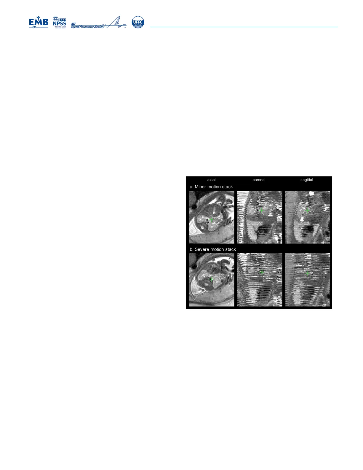 Deformable Slice-to-Volume Registration for Motion Correction in Fetal   Body MRI