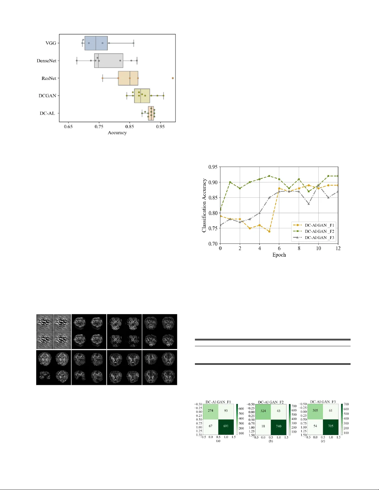 DC-AL GAN: Pseudoprogression and True Tumor Progression of Glioblastoma   Multiform Image Classification Based on DCGAN and AlexNet