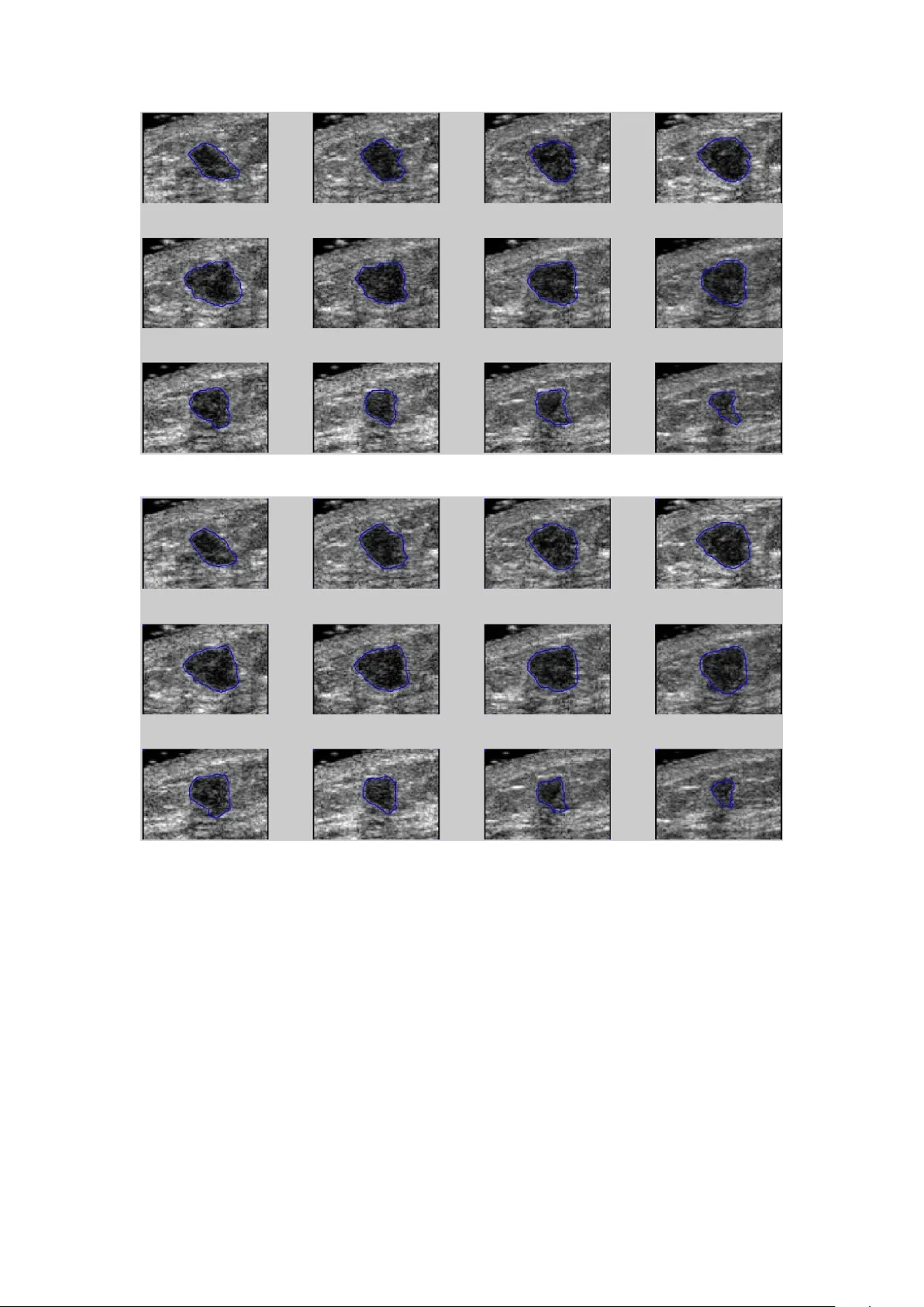 3D Contouring for Breast Tumor in Sonography