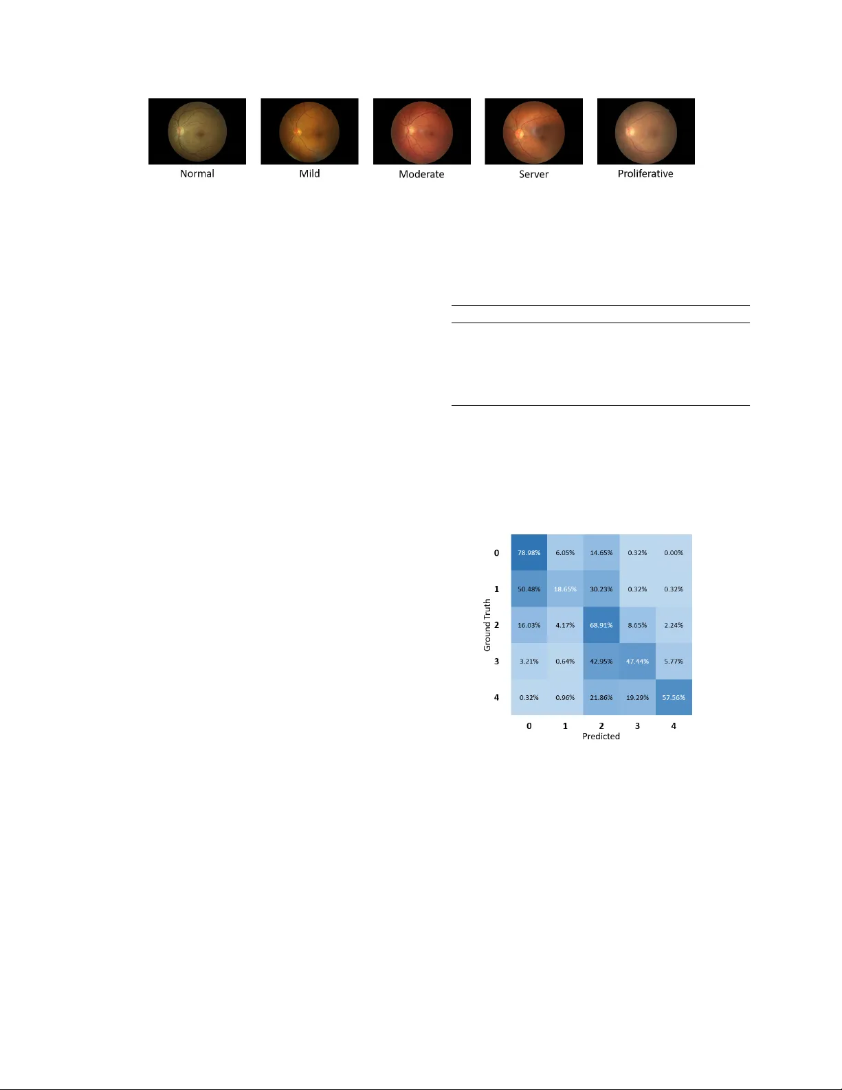 BiRA-Net: Bilinear Attention Net for Diabetic Retinopathy Grading