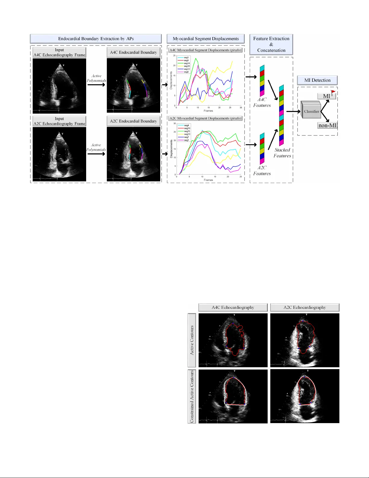 Early Myocardial Infarction Detection over Multi-view Echocardiography