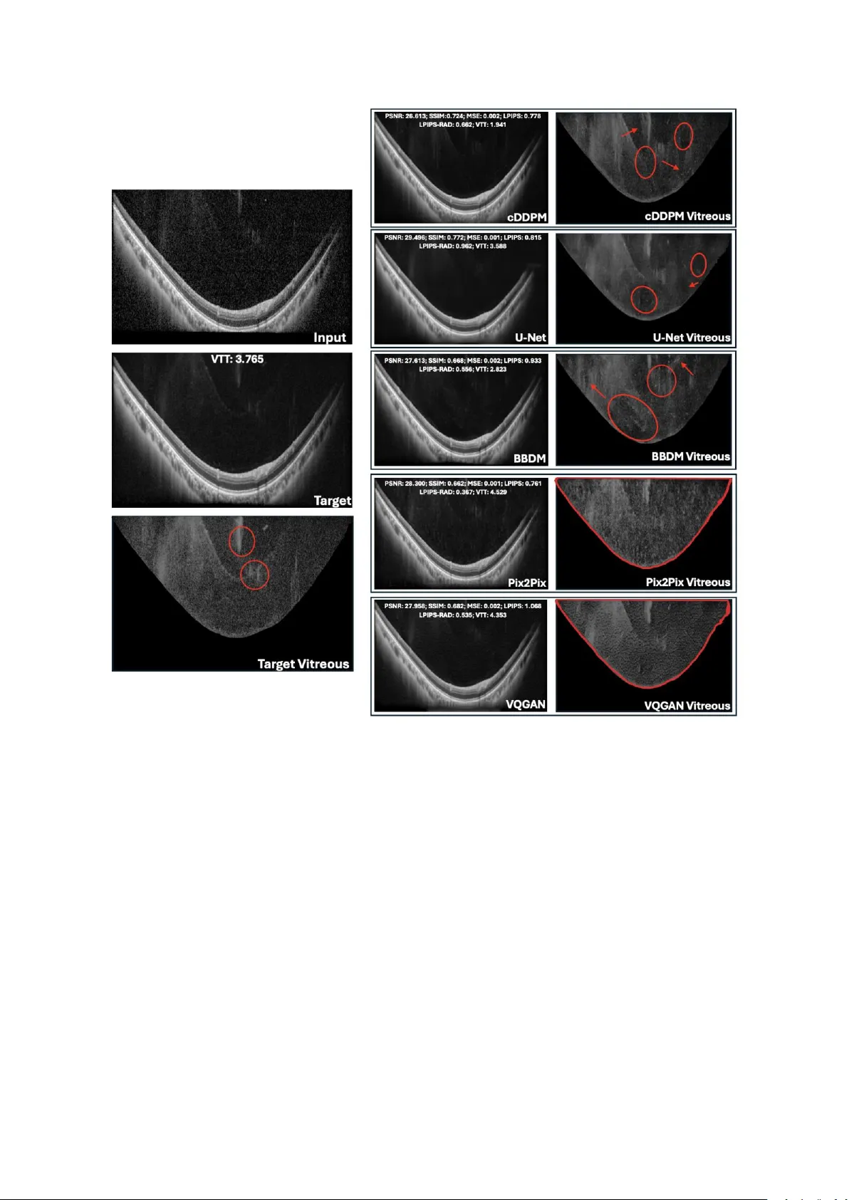 Deep Generative Models for Enhanced Vitreous OCT Imaging