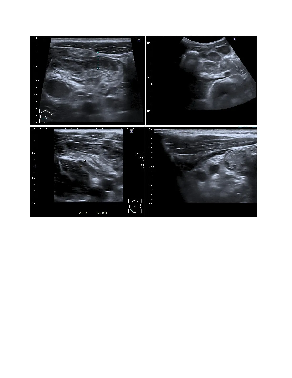 Pediatric Appendicitis Detection from Ultrasound Images