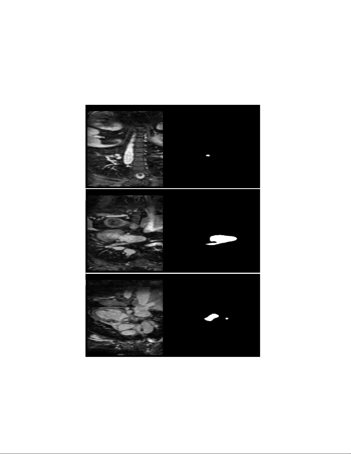 Left Atrial Segmentation with nnU-Net Using MRI