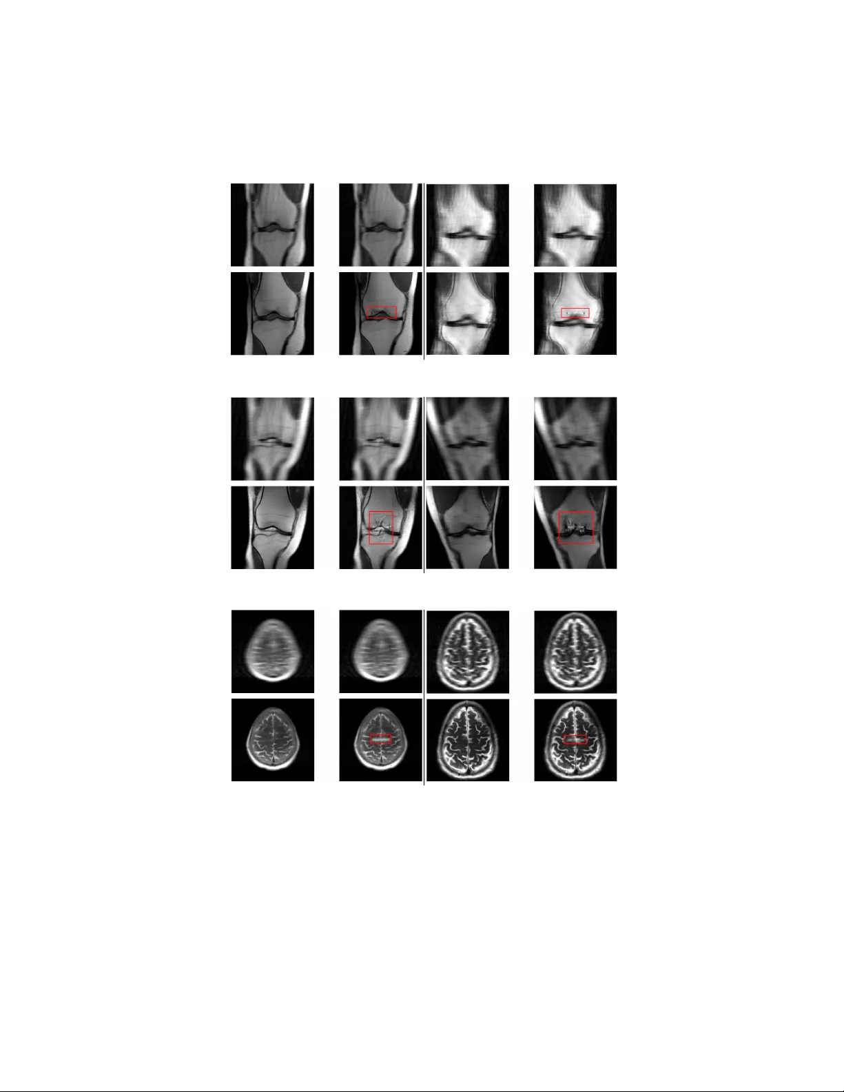 Triggering hallucinations in model-based MRI reconstruction via adversarial perturbations
