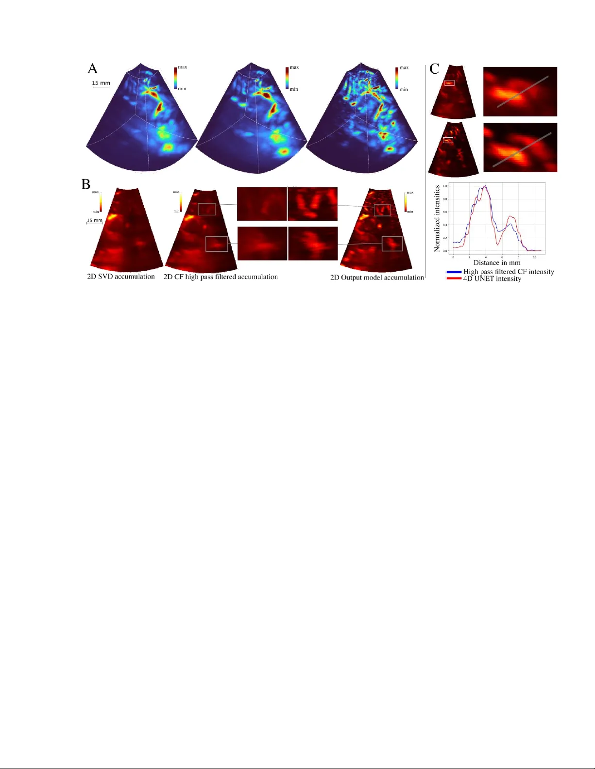 4D-UNet improves clutter rejection in human transcranial contrast enhanced ultrasound