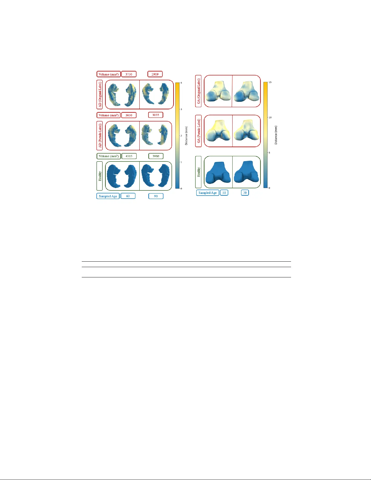 Self-supervised Disentanglement of Disease Effects from Aging in 3D Medical Shapes